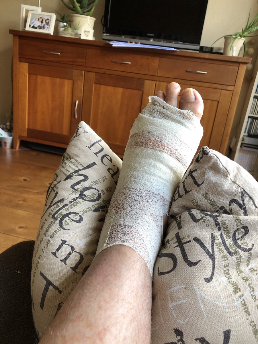 JaccoScheer's tweet photo. Soms is het niet handig als je een wit voetje wilt behalen. Ben nu 5 hechtingen rijker.
#auw #ehbo https://t.co/0WPGqQjCue