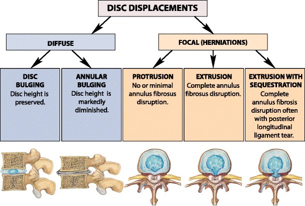 abc of degenerative spine