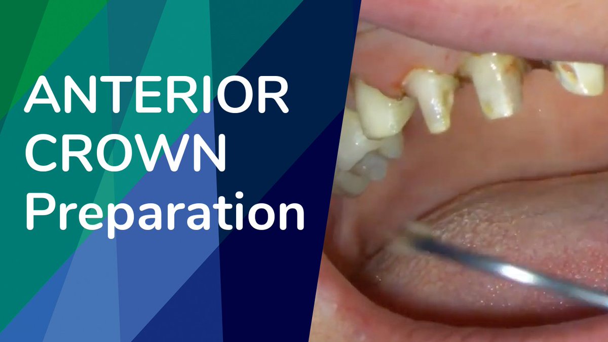 Watch Dr. Heath Lampee perform an Anterior Crown Preparation in our most recent YouTube video: youtu.be/fgV4qou9zl8. 
#Dentistry #DentalCE #AnteriorCrownPrep #AnteriorCrownPreparation