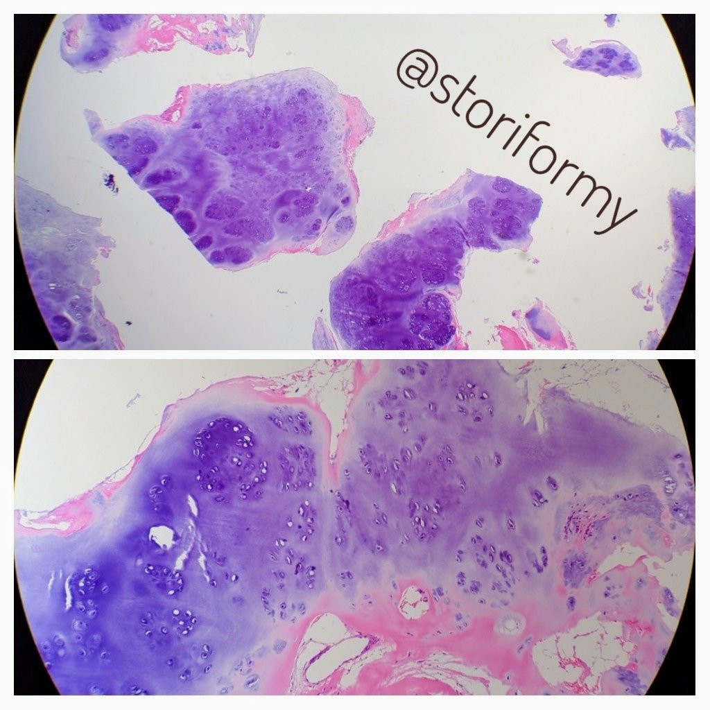 MolecularDoc's tweet image. Enchondroma: well-circumscribed cartilagenous nodules encased by a thin rim of reactive bone. Correlate with imaging.