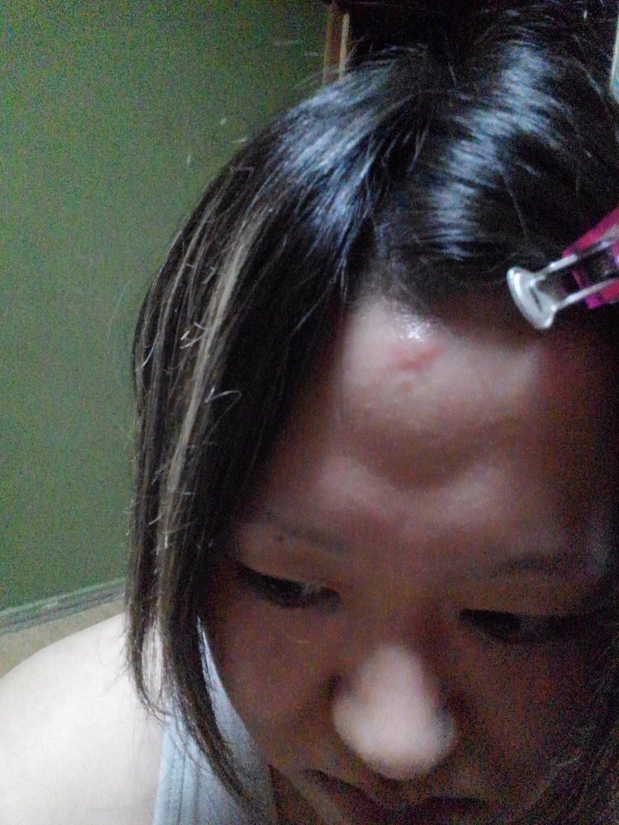仮 嫁 昨日おでこ噛まれた所 やっべー痒い てかたんこぶみたい