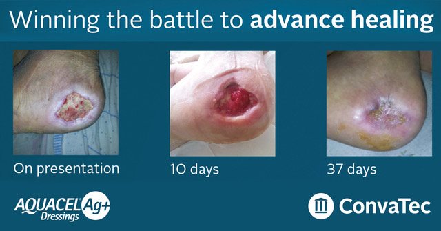 ConvaTecWoundUK's tweet image. This 6 month diabetic foot ulcer was transformed in just 5 weeks! 

Clinical signs → odour, exudate, slough and suspicious biofilm.
After treatment with AQUACEL® Ag+ dressings → peri-wound and wound bed visibly significantly improved. 

#MORETHANSILVER #AQUACELAg #Biofilm