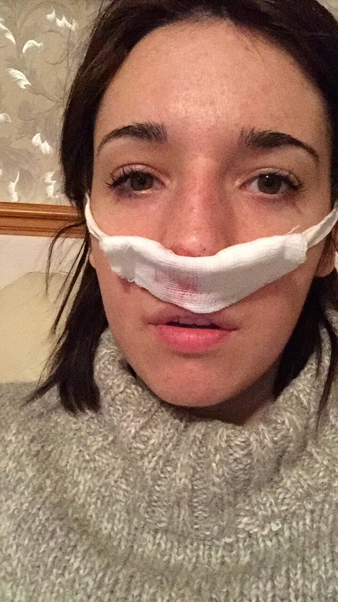 worm2092's tweet photo. @velvetgh0st I had it three years ago, painwise was bearable, only lasted a couple of weeks. Fully recommend getting sterimar spray to help clean anything out. You’ll feel tons better after. Had the double surgery a year later and that was worse. You’ll feel pressure around your eyes and nose https://t.co/DDpzM5hYzH