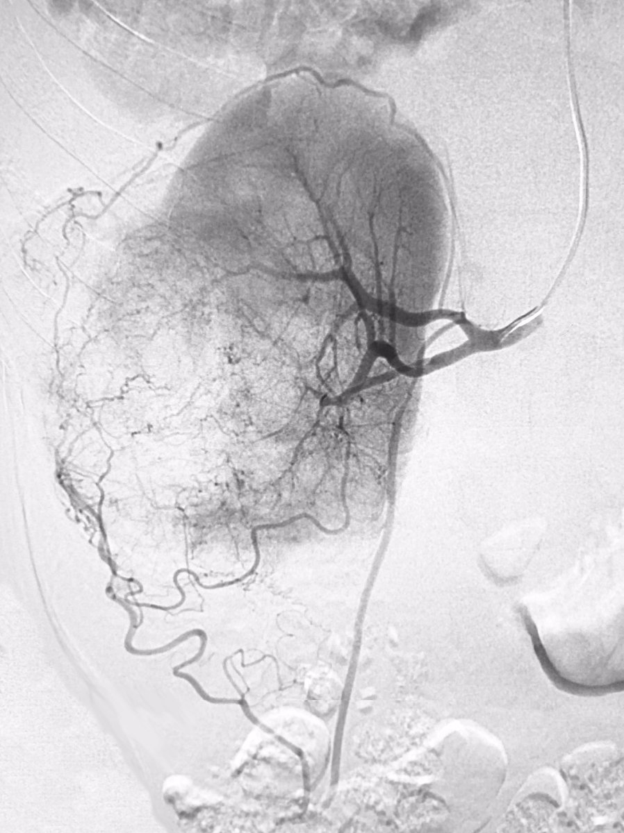 MTV_IR's tweet photo. 36 y/o M w/#metastaticrenalcellcarcinoma w/#hematuria. 10 cm R #renalcellcarcinoma w/significant capsular supply. #Sniperballoon, alcohol/Lipiodol #intraarterialablation with additional #Embozene particles &amp; #interlockcoils. Hematuria resolved post procedure.
#MTVIR #RadialFirst https://t.co/Dz6oqFG7vJ