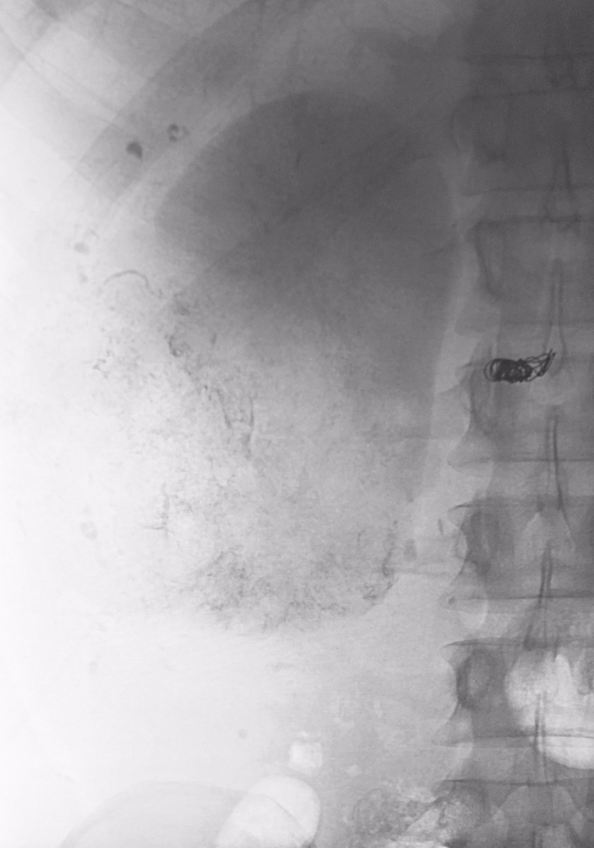 MTV_IR's tweet photo. 36 y/o M w/#metastaticrenalcellcarcinoma w/#hematuria. 10 cm R #renalcellcarcinoma w/significant capsular supply. #Sniperballoon, alcohol/Lipiodol #intraarterialablation with additional #Embozene particles &amp; #interlockcoils. Hematuria resolved post procedure.
#MTVIR #RadialFirst https://t.co/Dz6oqFG7vJ