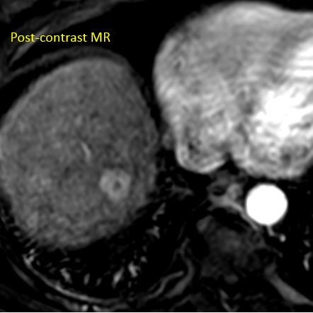 Routine CT from ER, h/o cirrhosis. Most of these are done in portal venous phase alone, and it is easy to miss lesions.
Not with #SpectralCT!
Low keV images increase contrast resolution, making lesions stand out. Followup MR showed LiRADS 5 "observation". Treated with chemoembo.