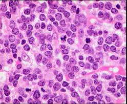 EMPRESALUD's tweet photo. ¿Qué es la Leucemia? https://t.co/yaBIueWdh4 https://t.co/vtQysFDnmo