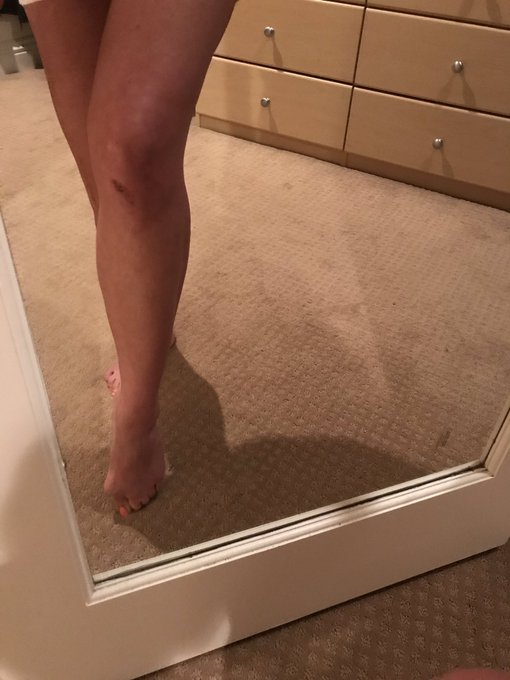 Sometimes you just want to wear something to make you feel beautiful but bruises won&rsquo;t let you.. https://t<a href="/tag/redcarpet"class="tags"><span>#redcarpet</span></a>