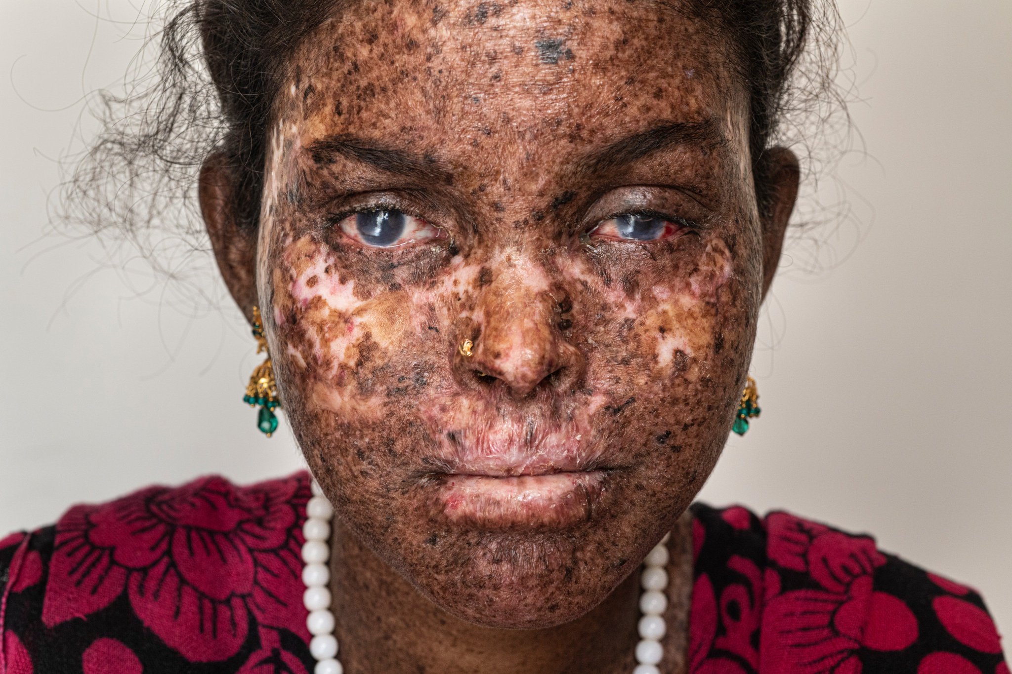 The Telegraph Twitterissa Sai Medha Bondagiri Is Just 19 But Looks Old Beyond Her Years Thanks To The Devastating Effects Of Xeroderma Pigmentosum Xp A Rare Genetic Condition That Makes The Sun S