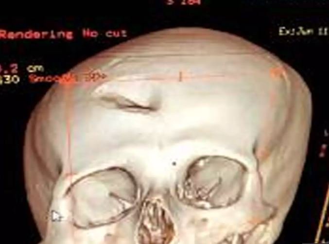 Doctors Paribaha Mukhopadhyay & Yash Tekwani were beaten up severely.Dr. Mukhopadhyay suffered a depression fracture in the right frontal lobe of the skullhad episode of convulsion after being hit. Future convulsions could not be ruled out. Will need medical care lifelong