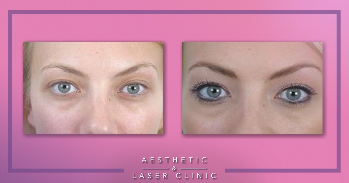 The semi-permanent make-up procedure is completely safe and effective and used for a variety of cosmetic enhancements such as eyebrows, eyeliner and eyelash enhancement. After just one procedure you can have stunning smudge free makeup.
aestheticlaser.co.uk.
#Devonhour #beauty