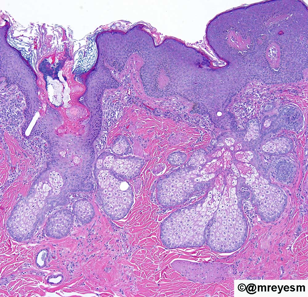 mreyesm's tweet photo. A frequent non-melanocytic #nevus seen in #PediPath: #NevusSebaceous. Note prominent sebaceous glands, some of which open directly onto the epidermal surface, and apocrine sweat glands. #Dermpath https://t.co/PthV05pS8b