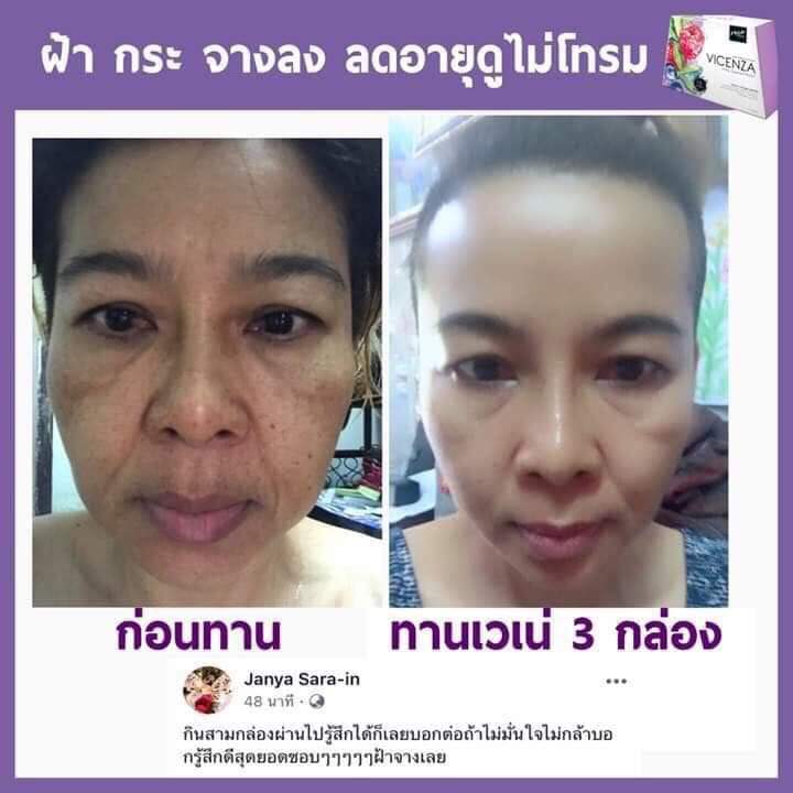IndazaV's tweet photo. 💢  ฝ้า จางลง ริ้วรอยตื้นขึ้น หน้าเด้ง อิ่มน้ำ
 #ไม่ต้องเสี่ยงซื้อครีมที่มีสารอันตราย  
เสี่ยงหน้าบาง ฝ้า กลับมาเป็นหนักกว่าเดิม

😀ฝ้า กระ เกิดจากเม็ดสีผิวที่ผิดปกติ ฟื้นฟูจากภายใน ผิวสว่างใสแน่นอน
.
#VicenzaPlus ช่วยได้ https://t.co/nDMeTFzMmG