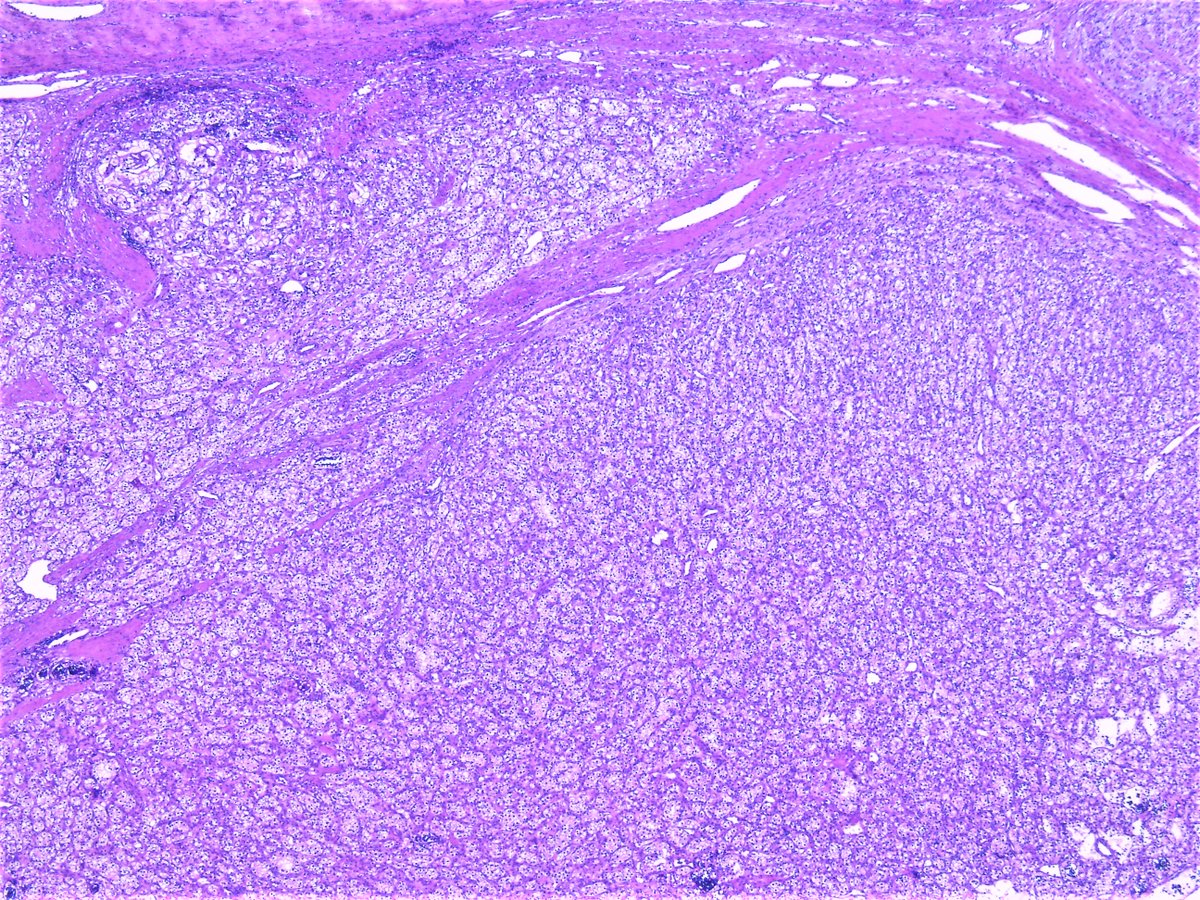 Patholwalker's tweet photo. Clear cell renal cell carcinoma (metastatic). thyroid, hemithyroidectomy. #pathology https://t.co/xTBqf2ouea