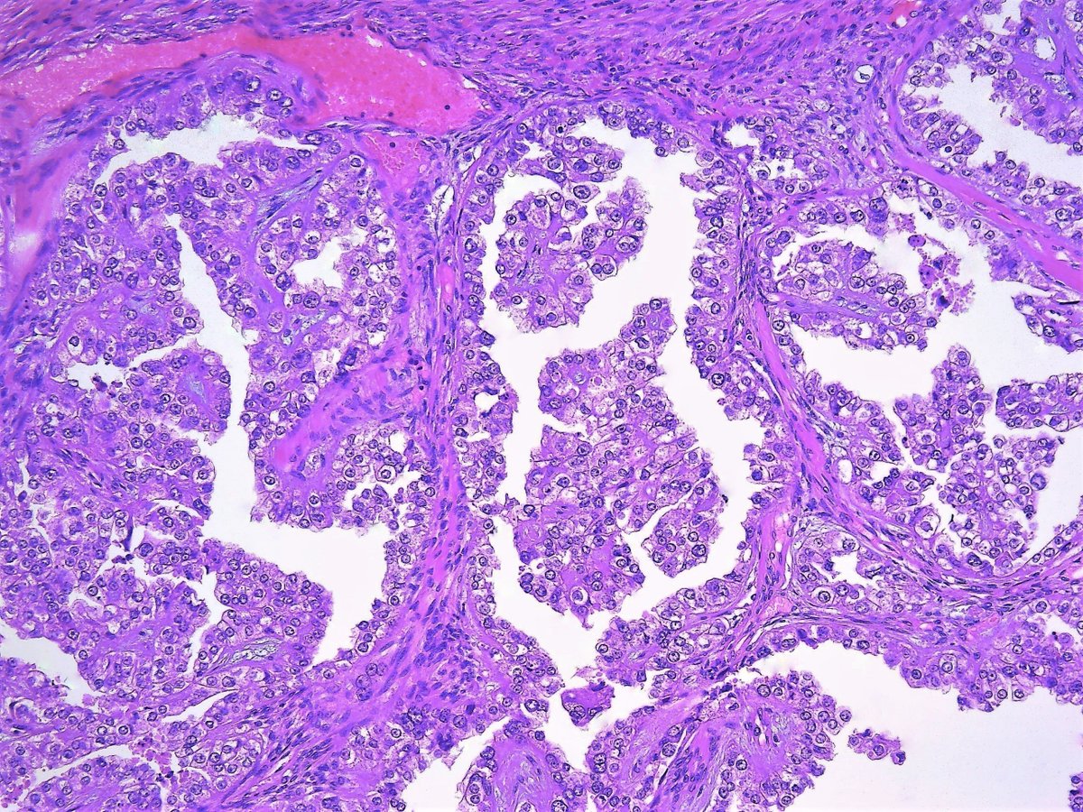 Patholwalker's tweet photo. Clear cell carcinoma. Ovary, oophorectomy and peritoneal lavage cytology. #pathology #Gynpath https://t.co/SooWTjUhXF