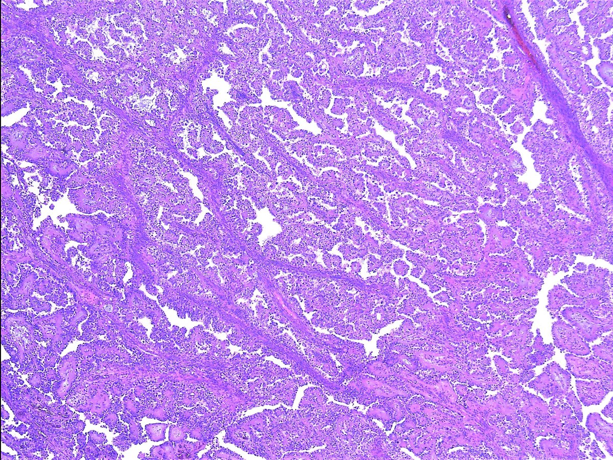 Patholwalker's tweet photo. Clear cell carcinoma. Ovary, oophorectomy and peritoneal lavage cytology. #pathology #Gynpath https://t.co/SooWTjUhXF
