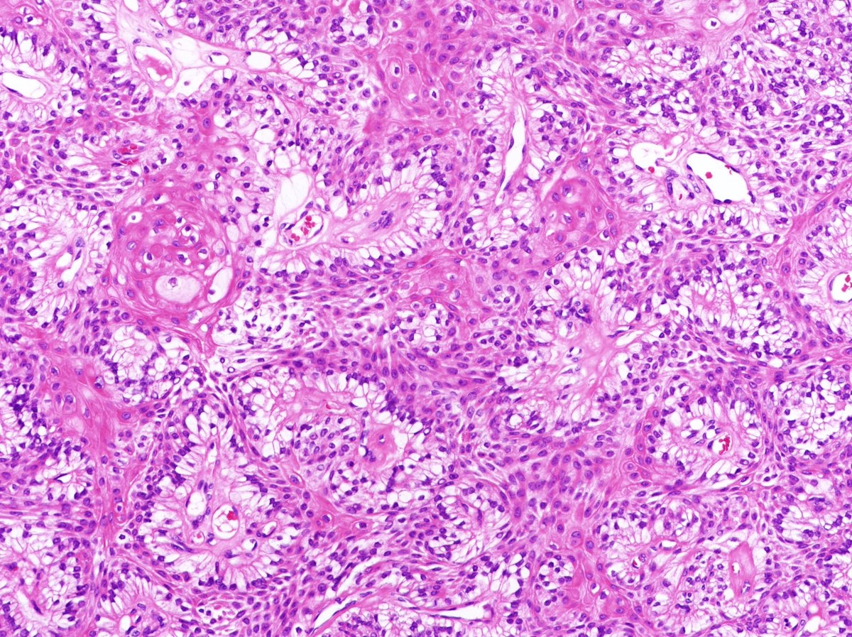 Patholwalker's tweet photo. Clear cell hidradenoma. Skin, resection. #pathology #dermatopathology https://t.co/5GXGrTXU5m