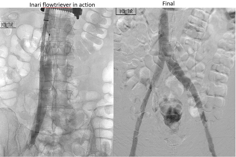 Pt with acute iliocaval #DVT through calves and severe leg swelling with recent fractures and hemarthrosis, tPA drip not an option. #Inari flowtriever and laser-assisted #filterOUT got the job done, w rapid resolution of edema. @SIRRFS @SIRspecialists