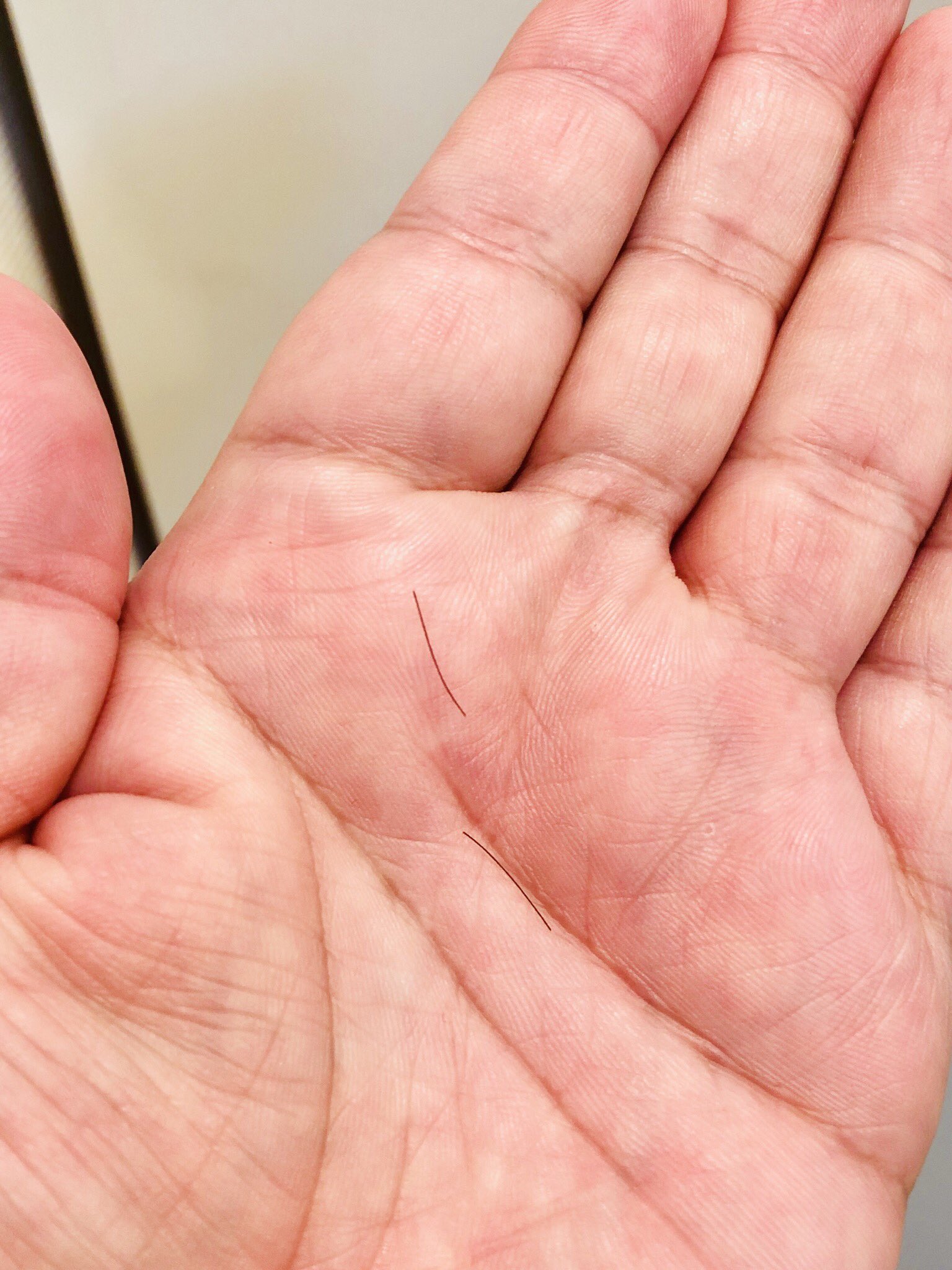 ドランクドラゴン塚地武雅 ここんとこ 歩くと左の足の裏の 拇指球 ぼしきゅう という ところが痛くて 触ると 打撲とも魚の目とも違って よく見ると トゲが刺さってる跡が 爪切りや毛抜きを駆使し 引っ張ったらニュル と それなりの長さの髪の毛がっ