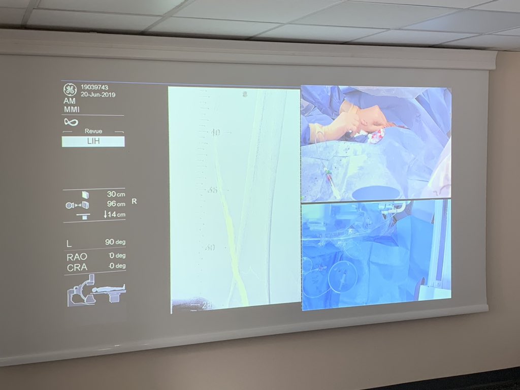 #workshop « journée périphérique » Partage d’expériences, de connaissances et de techniques interventionelles #endovascular périphériques. Traitements des lésions fémorales, iliaques... illustrés par des cas en live. #peripheralartery #femoral #Cardiotwitter