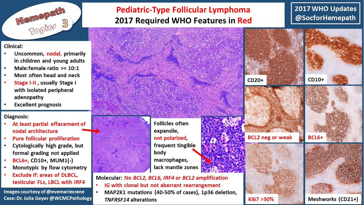 SocforHemepath's tweet photo. Time for more 2017 WHO updates! Pediatric-type follicular lymphoma usually presents as Stage I disease with excellent prognosis.
Must identify at least partial nodal effacement to rule out follicular hyperplasia which can rarely show CD10+ clones in this age group! #hemepath https://t.co/uqI8X4VPwd