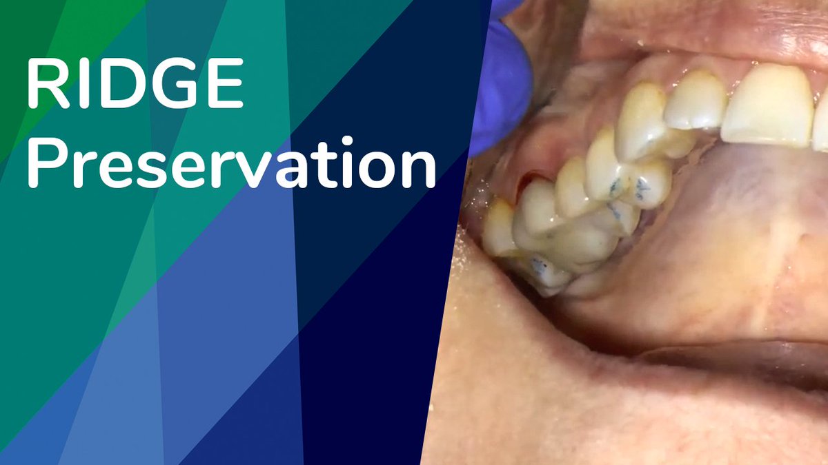 In today's video, <a href="/drlampee/">Heath Lampee</a> shows the extraction of #3 and the bone graft membrane for preservation. Watch it here: youtu.be/DJJ8cQcBQ0g
#dentistry #dentalCE #ridgepreservation