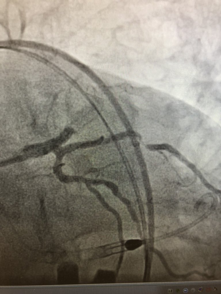 DrAmirKaki's tweet image. 66 yo CGS survivor presented with VF arrest.  Impella first followed by PCI. CPO .7 leaving lab.  POD 3 CPO 1.1 and MVO2 65 on P3.  #NSCI Architect @BillONeillMD and @Vetrovec leading the path to better survival.  @RajTayal2 @TimDSmithMD @duanepinto spreading knowledge on access