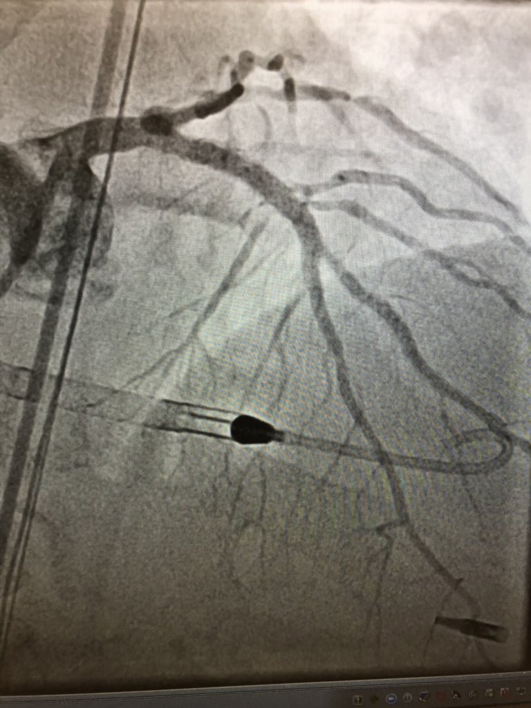DrAmirKaki's tweet image. 66 yo CGS survivor presented with VF arrest.  Impella first followed by PCI. CPO .7 leaving lab.  POD 3 CPO 1.1 and MVO2 65 on P3.  #NSCI Architect @BillONeillMD and @Vetrovec leading the path to better survival.  @RajTayal2 @TimDSmithMD @duanepinto spreading knowledge on access