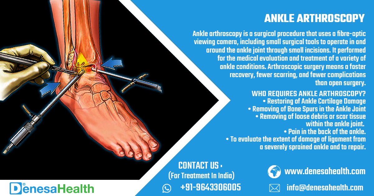 #AnkleArthroscopy
It's a surgical procedure that uses a fibre-optic viewing camera, including small surgical tools to operate in & around the ankle joint through small incisions.

#Treatment #CartilageDamage #AnkleJoint #FastRecovery #HealthTourism #MedicalAssistant #DenesaHealth