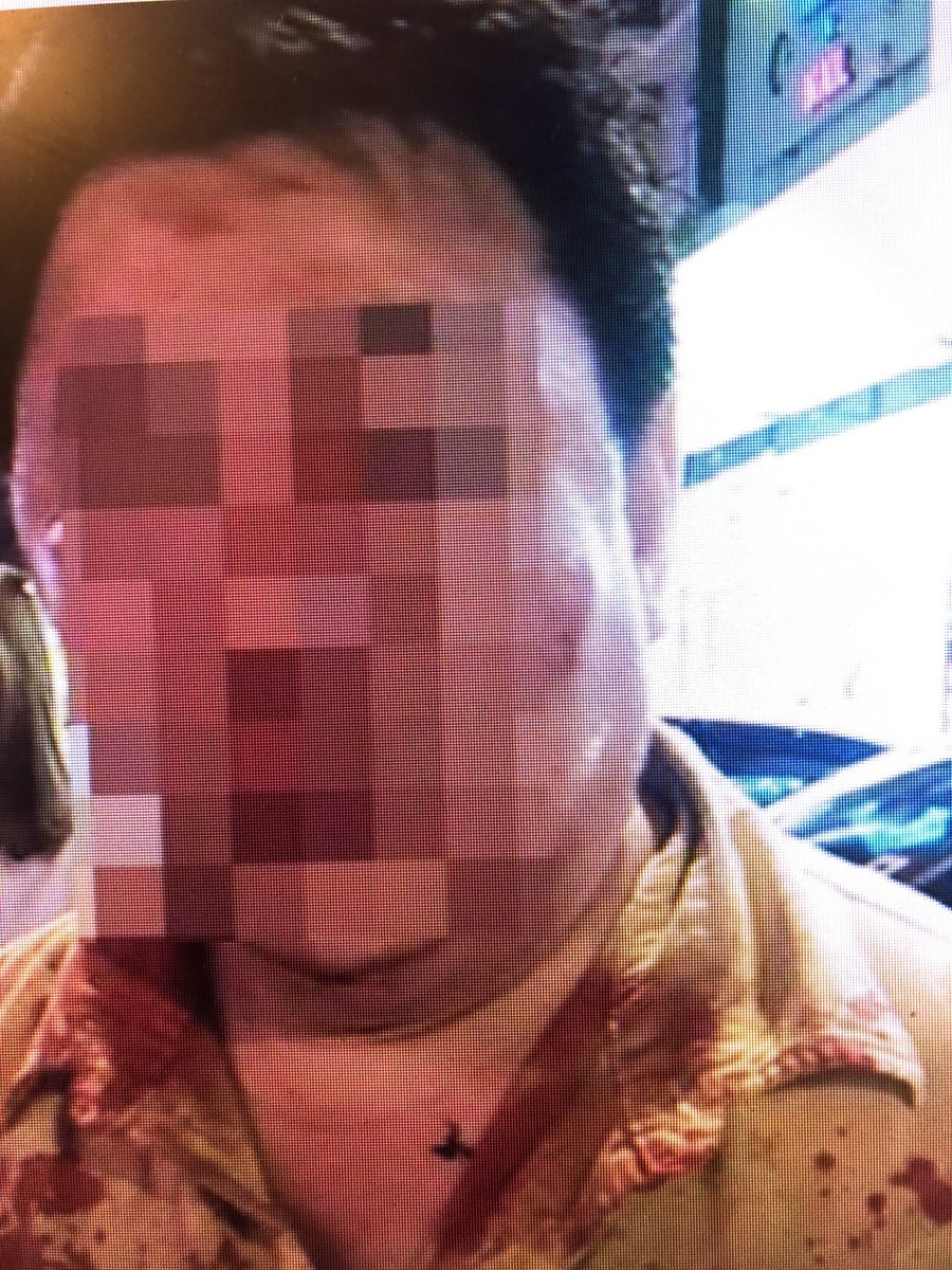 FareezAzmann's tweet image. #Pukul #Gaduh Suspek utama kes pukul lelaki di Cheras semalam ditahan jam 4.20 petang tadi. Suspek akui tidak puas hati kerana mangsa potong barisan. Mangsa patah tulang muka,hidung, pergelangan tgn kanan. Kes disiasat Seksyen 323/160 Kanun Keseksaan @501Awani #AWANINews