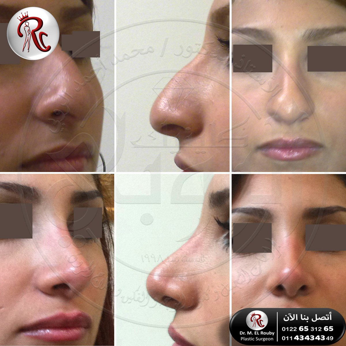 ELROUBYEGYPT's tweet photo. #rhinoplasty #nose_job #nosejob #تجميل_الانف #تجميل #انف #خشم https://t.co/dKe4boQsXM