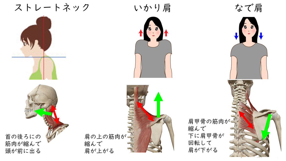 理学療法士キリツ 姿勢良くする人 En Twitter 肩こりで痛くなる筋肉は 首から肩や肩甲骨にかけてある 僧帽筋 頸部伸筋 肩甲挙筋 菱形筋 です ストレートネック 頸部伸筋が硬く 頭が前に いかり肩 僧帽筋 肩甲挙筋が硬く 肩が上がる なで肩 肩甲挙筋 菱形