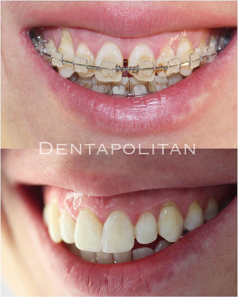 Dentapolitan's tweet image. ✨Üst çene darlığı vakalarında; yetişkin hastalarda, cerrahi destekli bir genişletme operasyonu olan kortikotomi operasyonları en güvenli yöntem olan piezo cerrahi ile yapılmaktadır.

#çeneameliyatı #çenegenişletme #piezosurgery #ortodonti #çeneestetigi #dentist #zahnarzt #diş