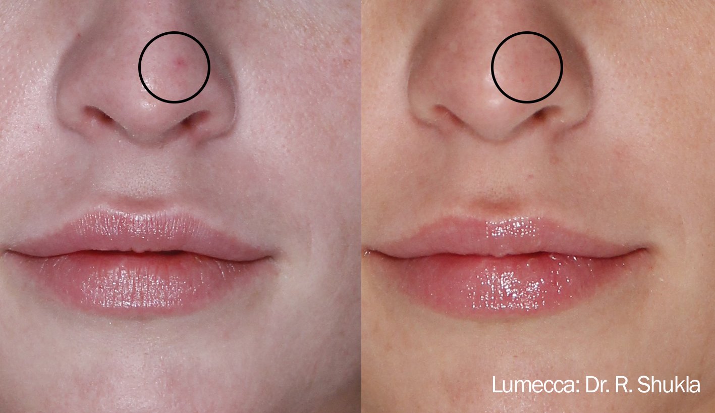 Фотоомоложение Lumecca INMODE