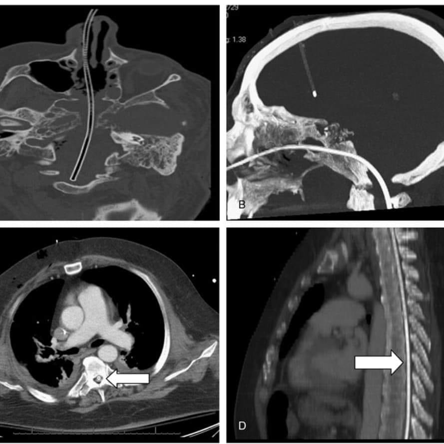 Well this makes me fear the NG in the setting of base of skull fracture.
Phenomenal image.
#FOAMed #trauma #emergencymedicine
(Thanks to FCCS for the image)