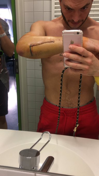 2 pic. I broke my fucking arm ? #brokenarm https://t.co/rmfqVdmmZS