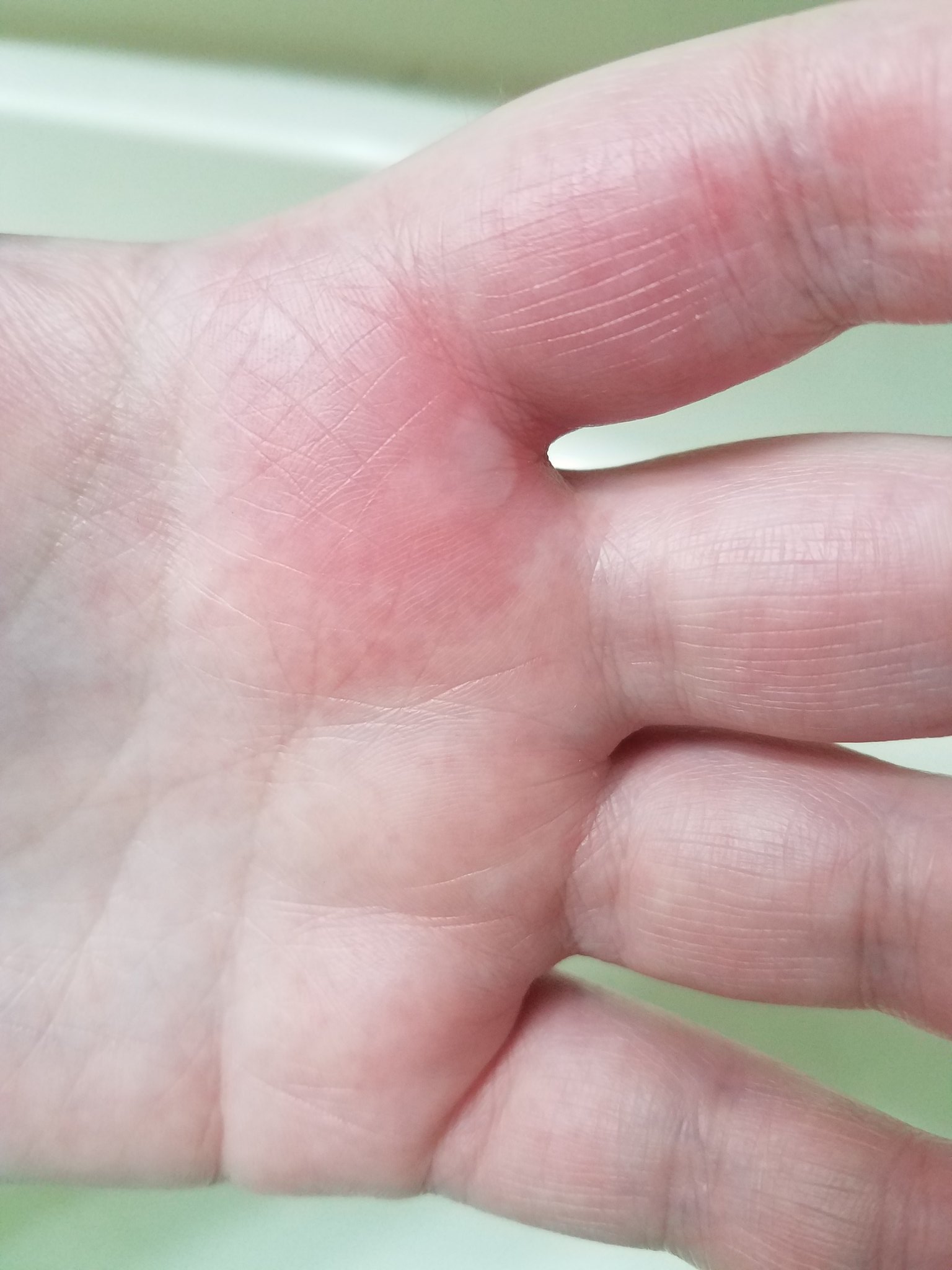 What to Do If You Touch a Hot Pan: Quick Soothing Tips