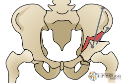 TirzaJanse's tweet photo. Hip hip hooray!

On this day in 2016, I underwent hip preservation surgery to treat #HipDysplasia. My pelvis was cut and shifted into a better position. Three screws were put in to hold it in place.

#HipDysplasiaAwarenessMonth #PAO #PeriacetabularOsteotomy #GanzOsteotomy https://t.co/fSM9OEF9mv