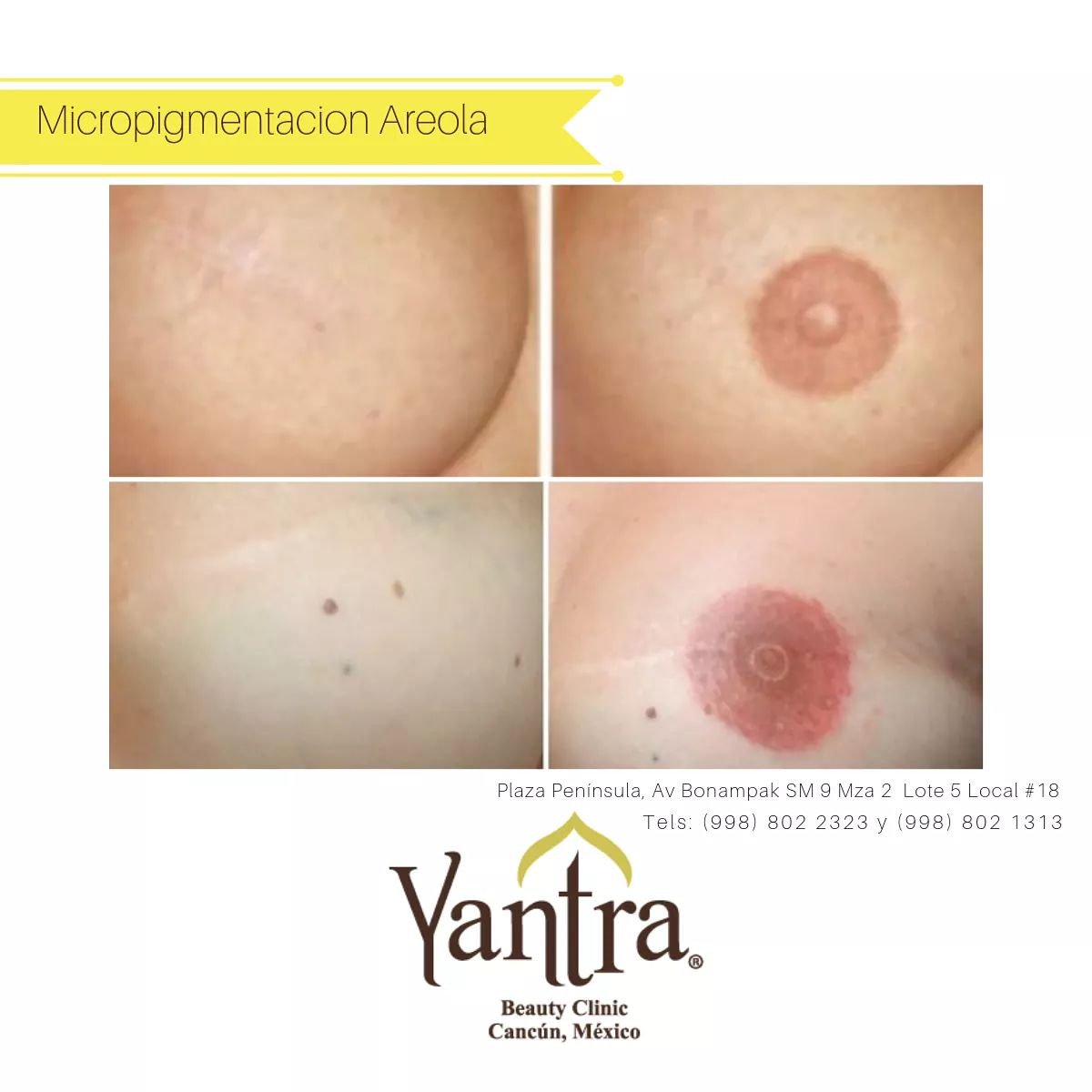 Micropigmentacion de areola mamaria, para cicatriz de operación  ven a conocer el servicio y acude a valoración en nuestra clínica