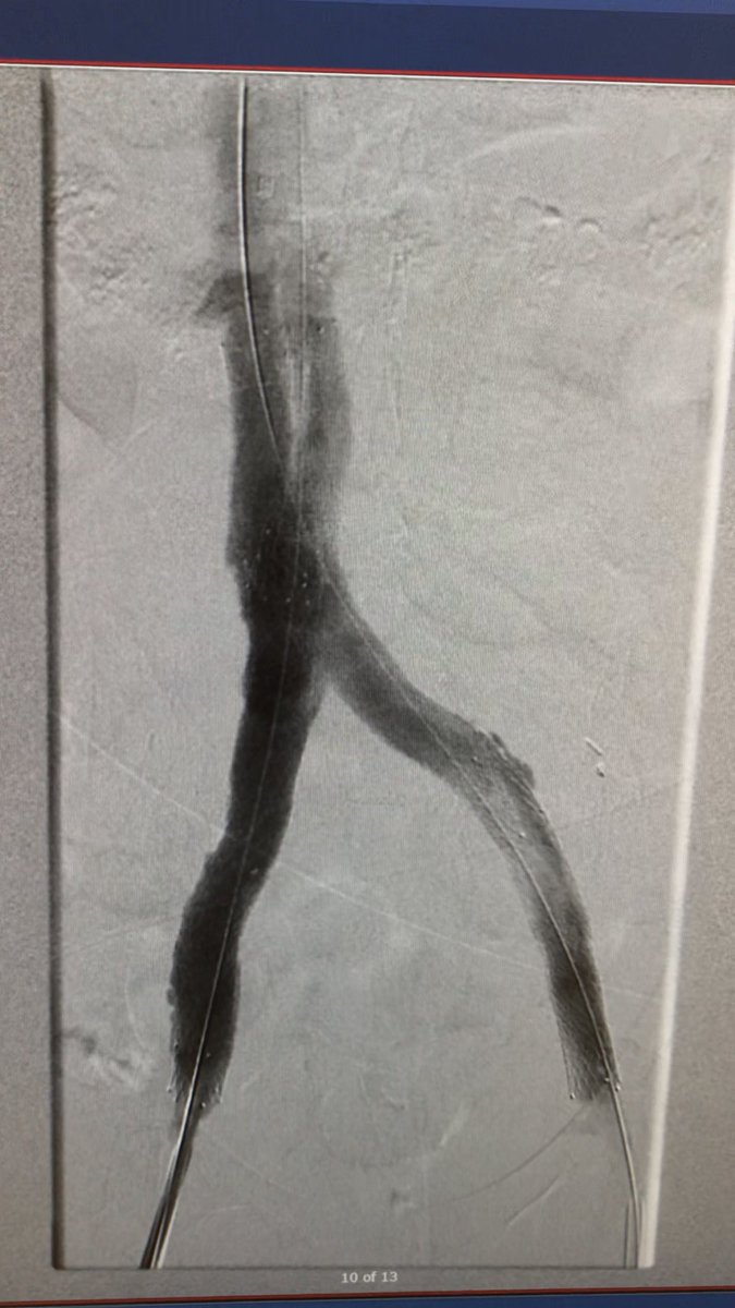 joeliechty's tweet photo. Post-phlebitic syndrome in a 55 year old female with an occluded filter and iliac veins. Fixed with Venovo stents and patience. #vascularsurgery #stent #svs #angioplasty #dvt #surgeon https://t.co/murLNbgAKh