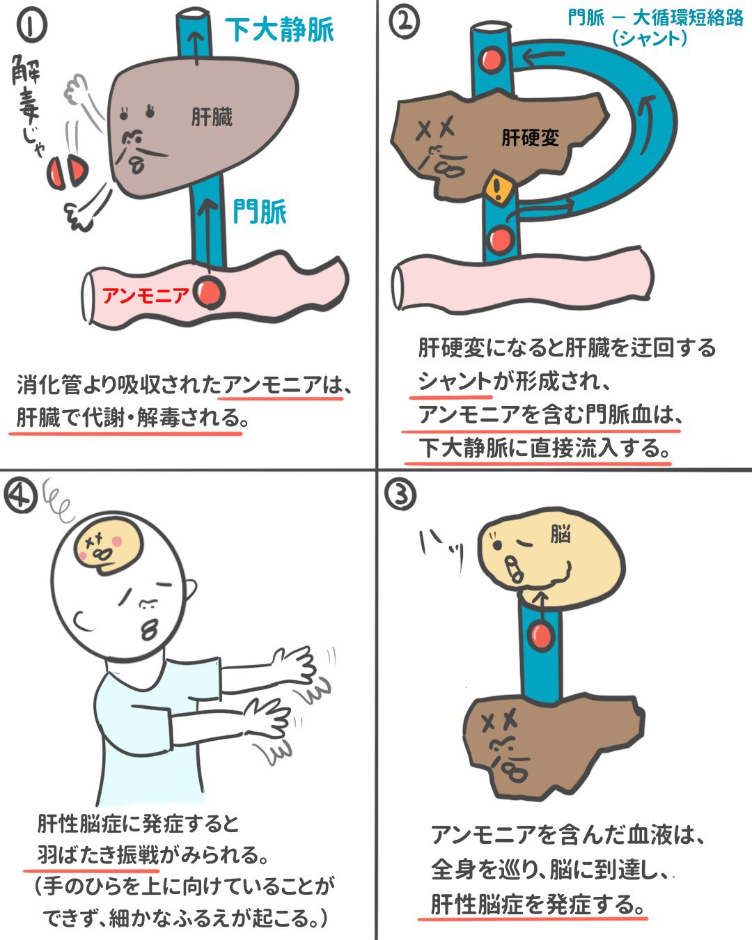 ゴロ 解剖生理イラスト 4コマ漫画で分かる 肝硬変 肝性脳症 羽ばたき振戦の流れ 4コマで読むと この流れが一気に理解できると思います T Co Qgghbtf5ar Twitter