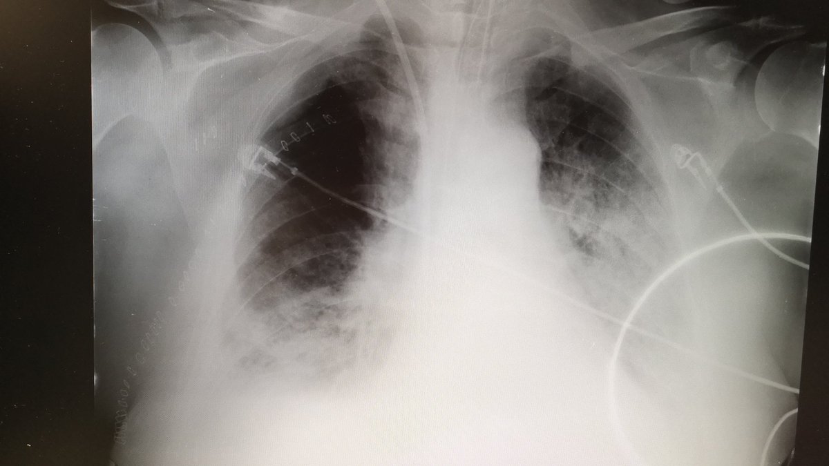 patriescu2's tweet photo. Today we're working hard! https://t.co/BEL3UCObLi #mechanicalventilation #MPD2019 https://t.co/qGivsL2GMf