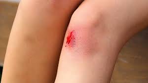 Jeane99816484's tweet photo. Ugh so this just happend 🤧😢 #rantoofast #tripped #ow https://t.co/rHQFZv8FFA