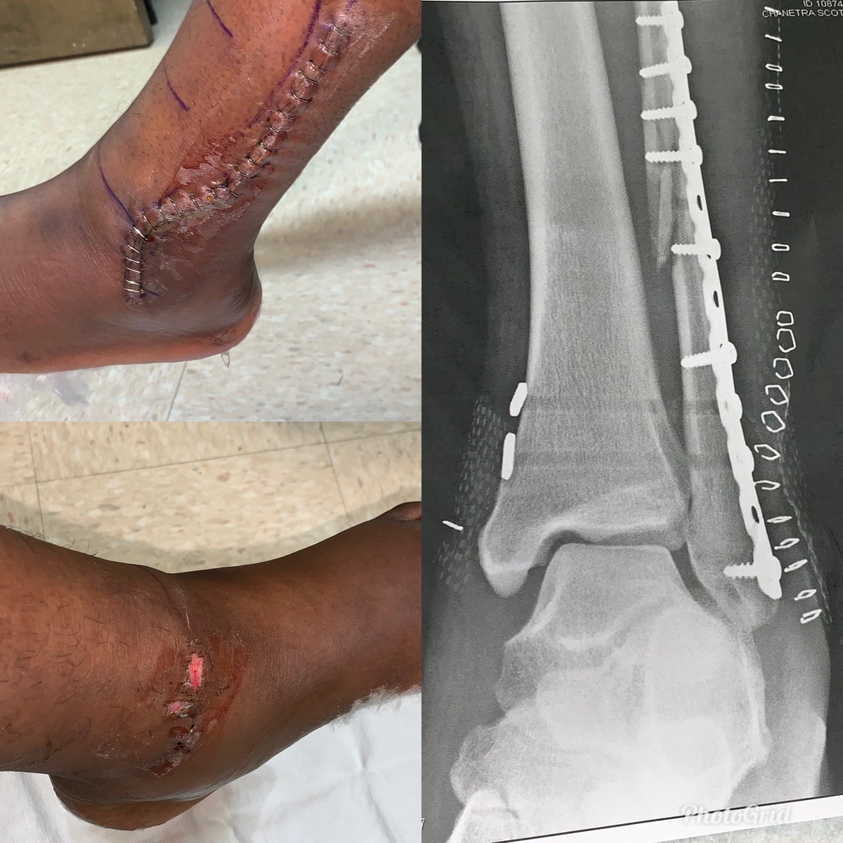 pmfmatteblacc's tweet photo. This how my ankle looked 🤕🤕 https://t.co/HRsB87pS2c