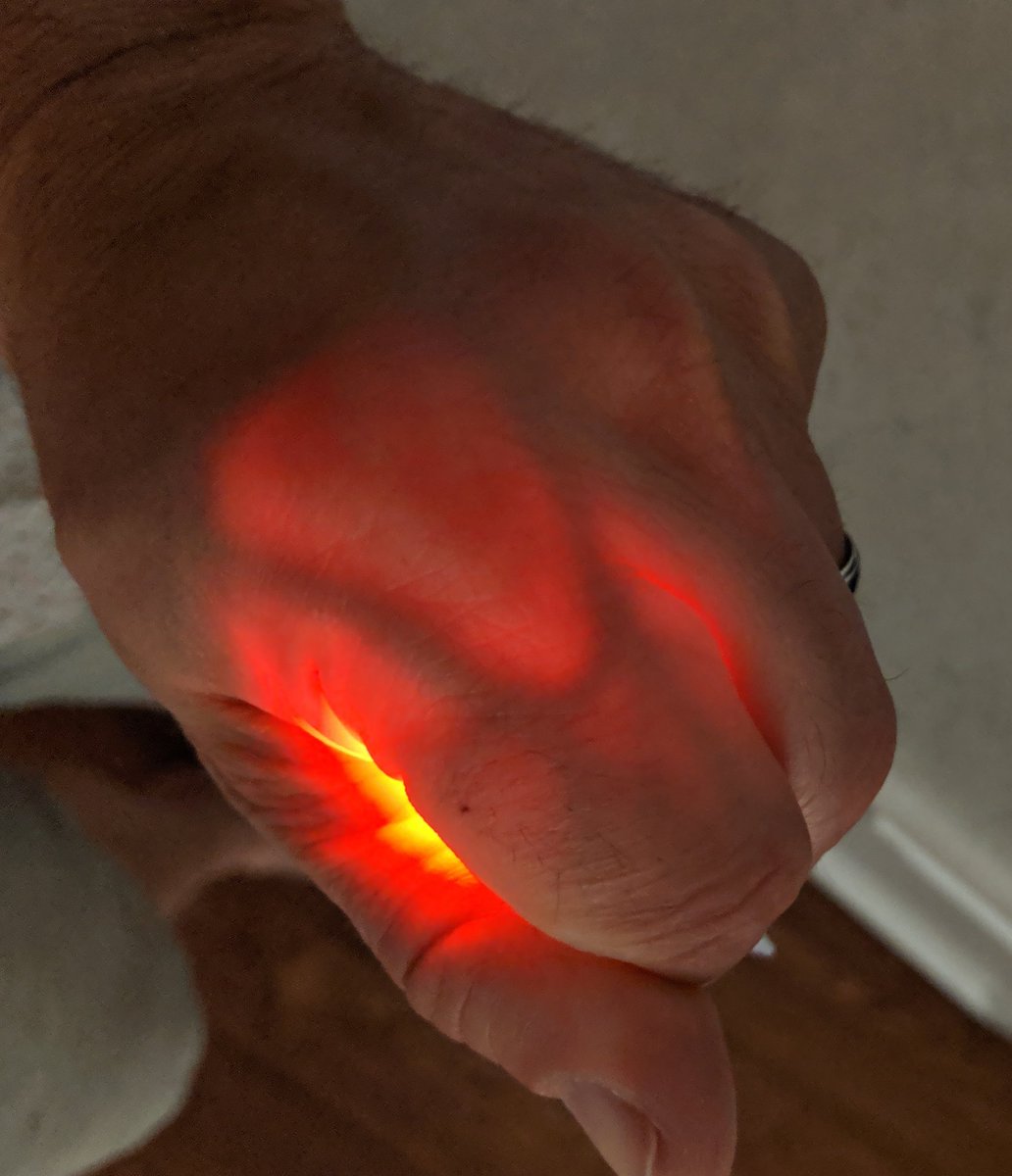 FAO Pediatricians/ anesthesiologists- invaluable tip for vasular access: a red bike light, cost 5 dollars, has saved me countless times for neonatal access. Don't waste money with expensive devices. See pic of my finger veins as example #pedsanes #pedscards #pediatrics