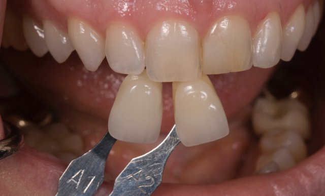 SpearEducation's tweet photo. Tips for taking photos that clearly show shade and surface texture: https://t.co/MpfWfWX7CC #dentistry #dental #dentist https://t.co/Qb7Ax58Mfi