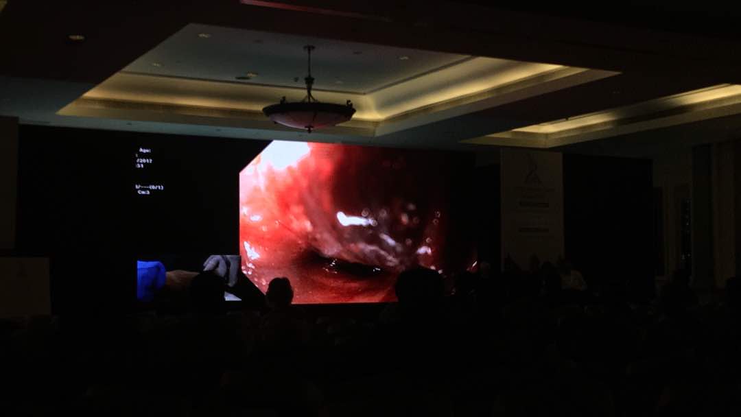 VipulroyR's tweet photo. POEM surgery in progress at #EndoMasterClass2017
#medicalconference #gastroconference #conference #gastroenterology #mumbaiconference https://t.co/GEGeEVYQOG