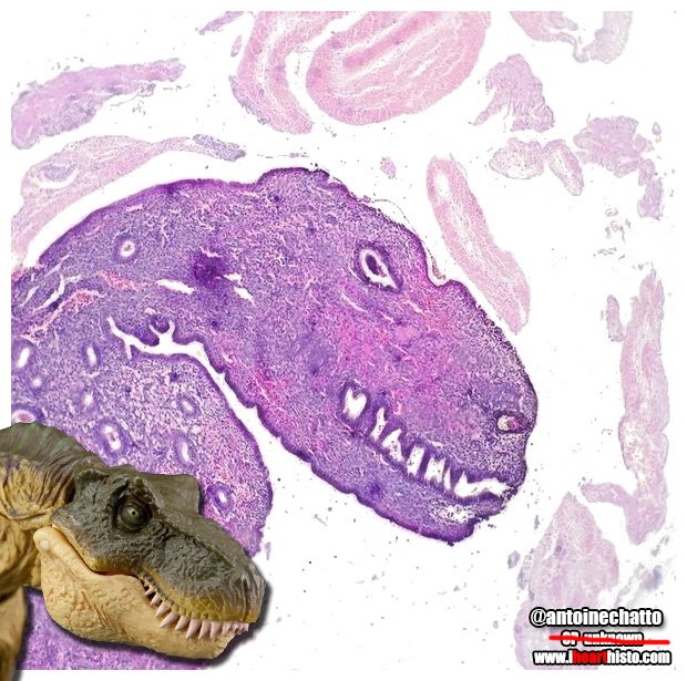 IHeartHisto's tweet image. 📢Announcement📢
We found author of famed Endometrial Rex!
#Pathology resident @antoinechatto!
Thanks to @jmgardner &amp;amp; @tlabiano at #SEAP2017V
