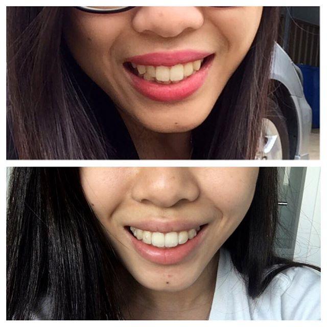 Invisalign's tweet photo. Your best smile is just waiting to be uncovered. https://t.co/bDPmNtnQFF #InvisalignSmile (Photo: @kewpid_) https://t.co/o13d3UnbHq