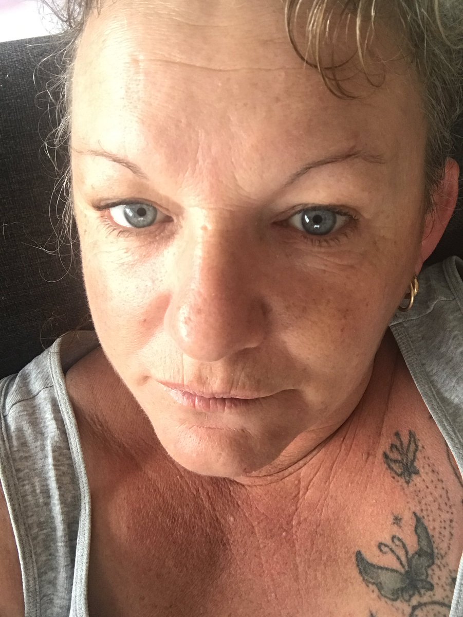 bad_aussie's tweet photo. Essure fragments &amp; PET fibres inside my body somewhere still makes me ill and looking ill. Life time essure victim😞 https://t.co/7lRR1GBbuu